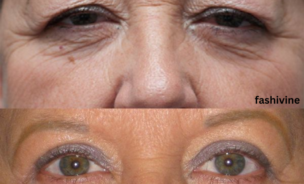 Brow Lift