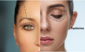 Decide Between Eyelid Surgery and Brow Lift